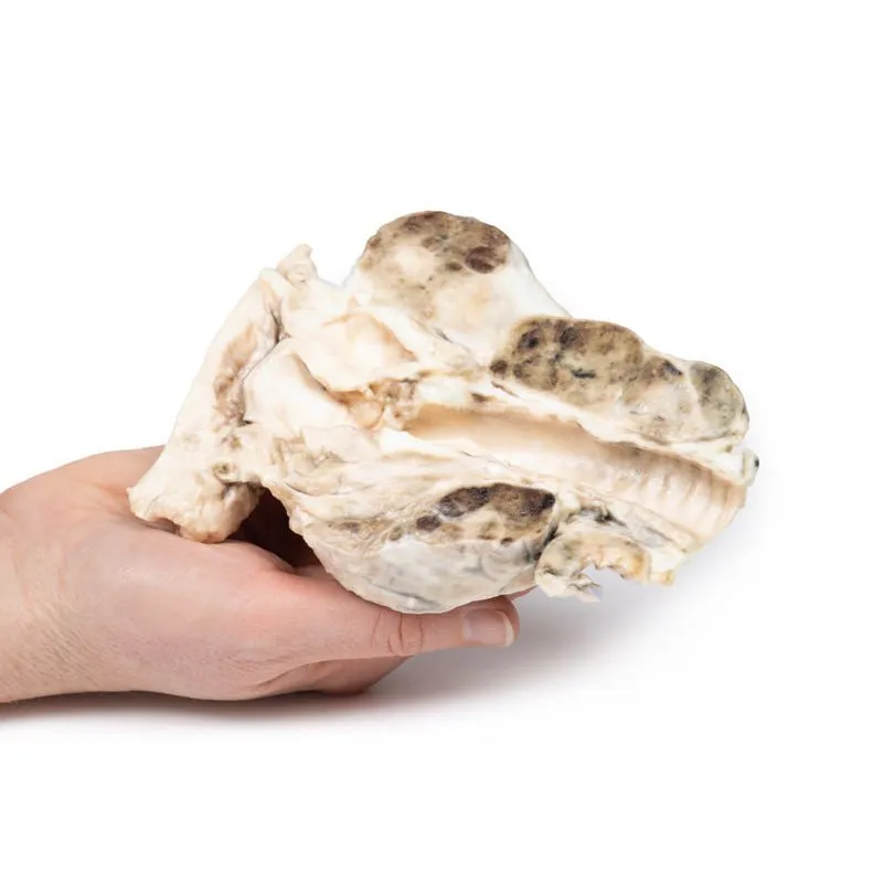 3D Printed Multinodular Goitre
